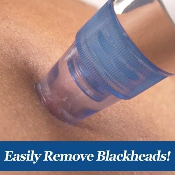 4-in-1 Electric Blackhead & Whitehead Remover Vacuum | Pore Cleaner Acne & Pimple Extraction Skin Care Device for Men & Women (White)