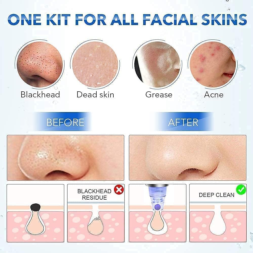 4-in-1 Electric Blackhead & Whitehead Remover Vacuum | Pore Cleaner Acne & Pimple Extraction Skin Care Device for Men & Women (White)